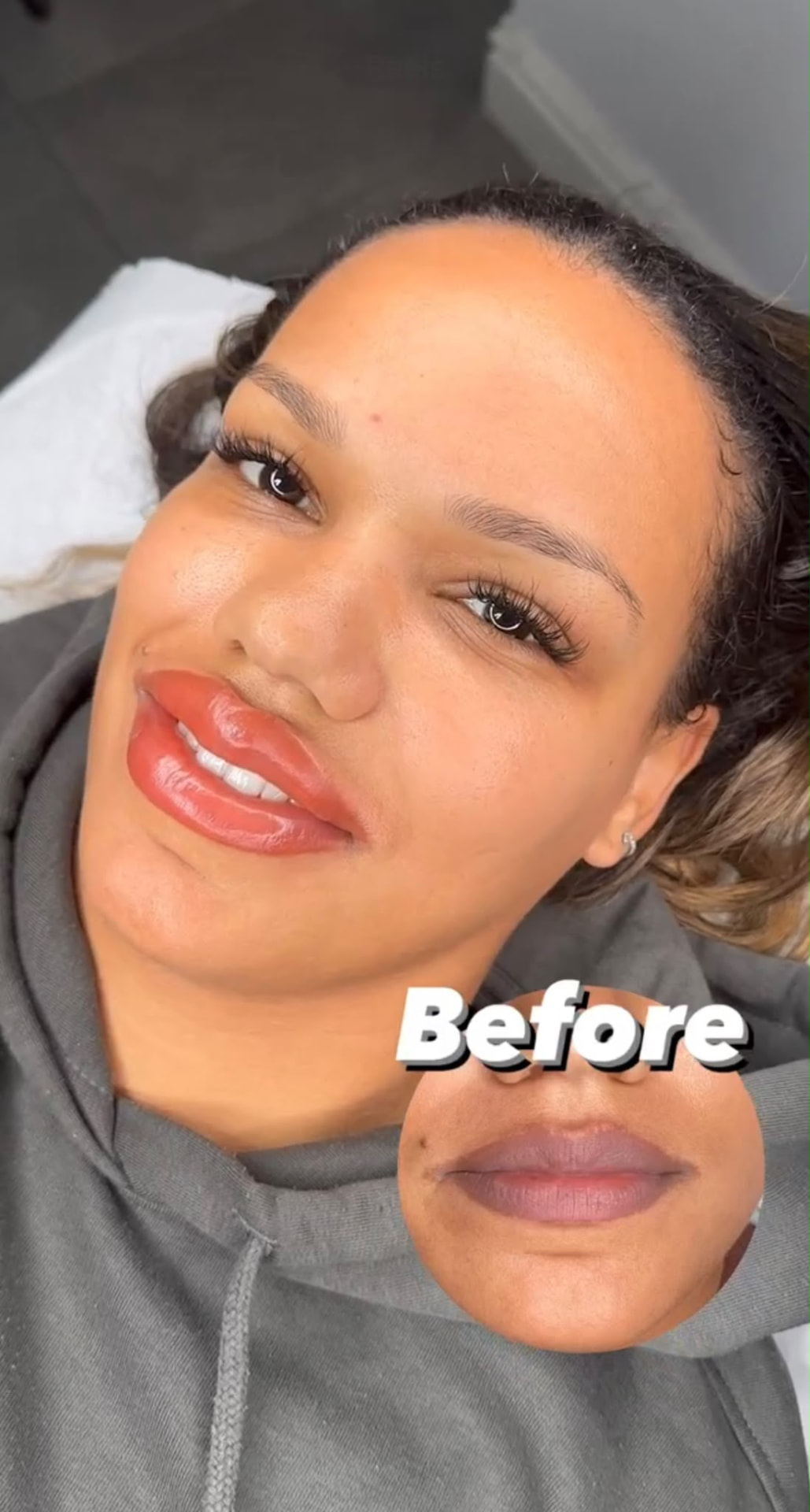 Before treatment photo of dark lips ready for lip neutralisation